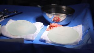 Tỷ lệ Bao xơ sau nâng ngực có nguy hiểm không? Sự thật về tỷ lệ 1-5% và cách phòng ngừa