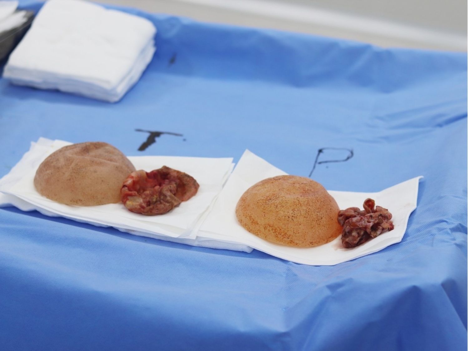 Bao xơ sau nâng ngực hình ảnh thực tế túi ngực bao xơ sau khi lấy ra