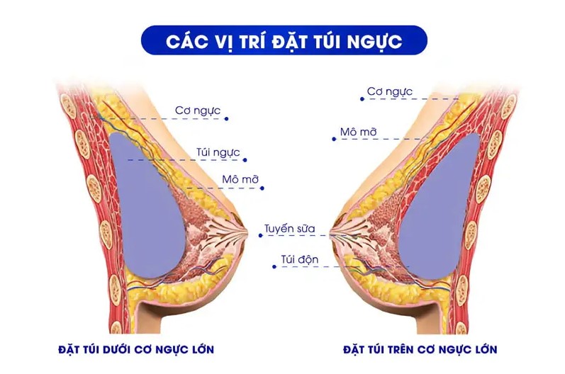 Sơ đồ túi ngực đặt dưới cơ qua đường mổ chân ngực giúp bảo tồn hoàn toàn tuyến sữa tại Kangnam.