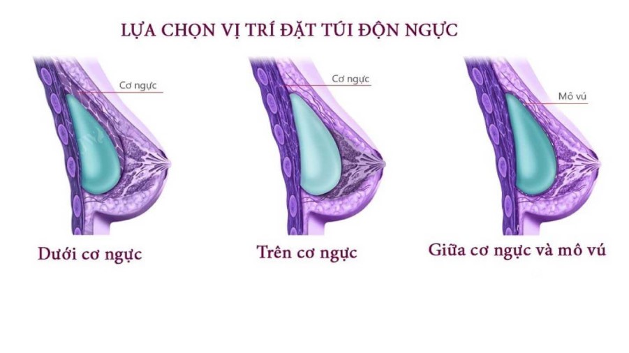 Sơ đồ giải phẫu tuyến vú phụ nữ cho thấy vị trí túi ngực nằm dưới cơ ngực lớn tách biệt hoàn toàn với mô tuyến sữa và ống dẫn sữa.