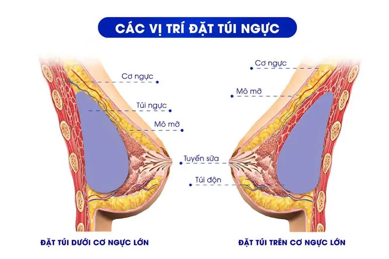 Mô phỏng vị trí đặt túi độn dưới cơ tại Kangnam giúp bảo tồn chức năng cho con bú]