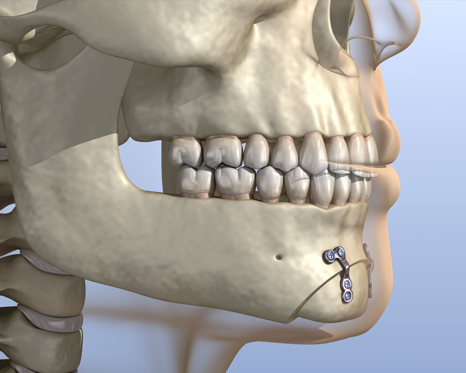 Kỹ thuật cố định sụn cằm bằng viets Titan chuyên dụng ngăn ngừa xô lệch