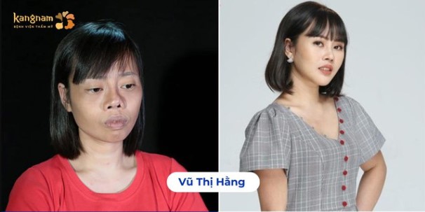 Sau 2 lần phẫu thuật tại Hành trình Lột xác, Hằng đã lấy lại gương mặt cân đối và sự tự tin trong cuộc sống