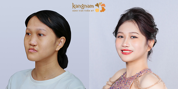 Trần Thị Xuân Mai trước và sau khi chỉnh hàm, thay đổi ngoạn mục