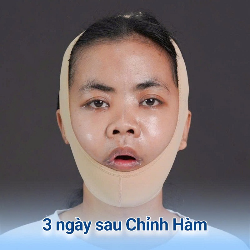 Tình trạng sưng nề mô mềm tạm thời của khách hàng sau 3 ngày chỉnh hàm tại Kangnam.