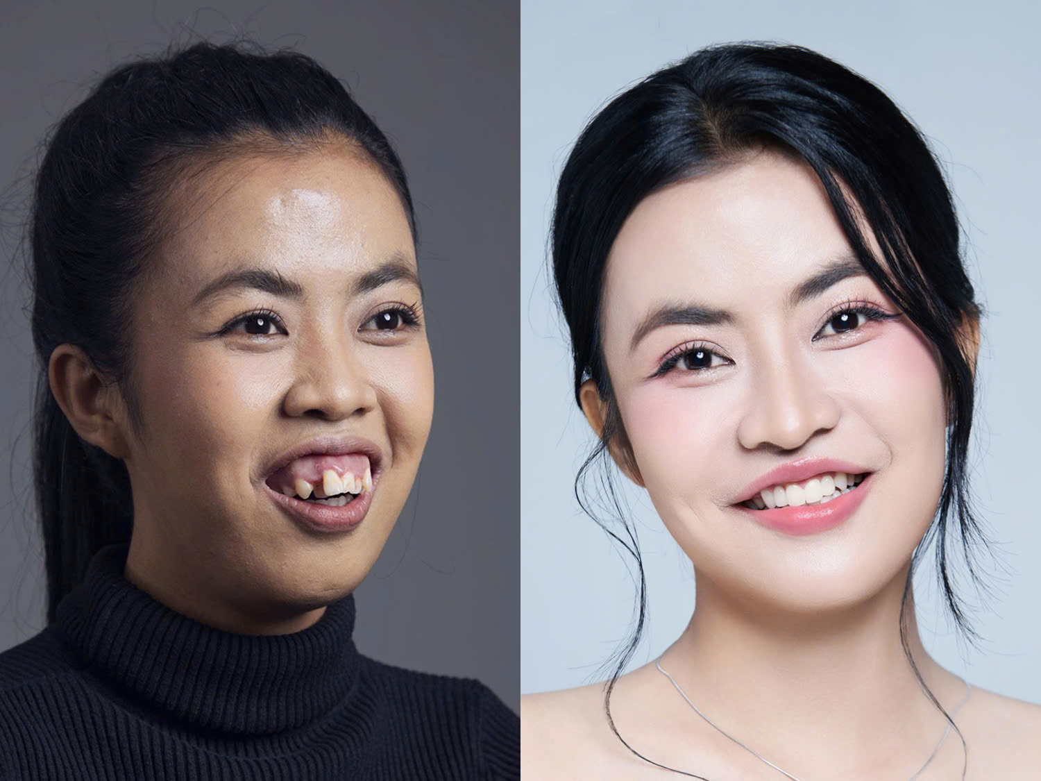 sự thay đổi ngoạn mục của My trước và sau phẫu thuật, khuôn miệng cân đối và đẹp hơn, sống mũi cao, mắt 2 mí