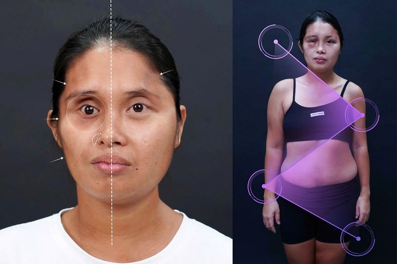 Lê Thị Yến mang cơ thể phát triển bất cân đối dạng “Ziczac” do đột biến nhiễm sắc thể