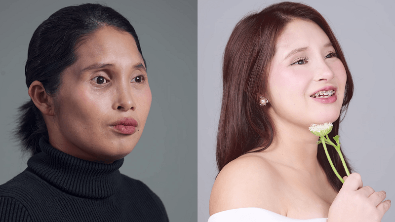 Chiến lược Tái cấu trúc toàn diện gương mặt và vóc dáng với 3 lần phẫu thuật