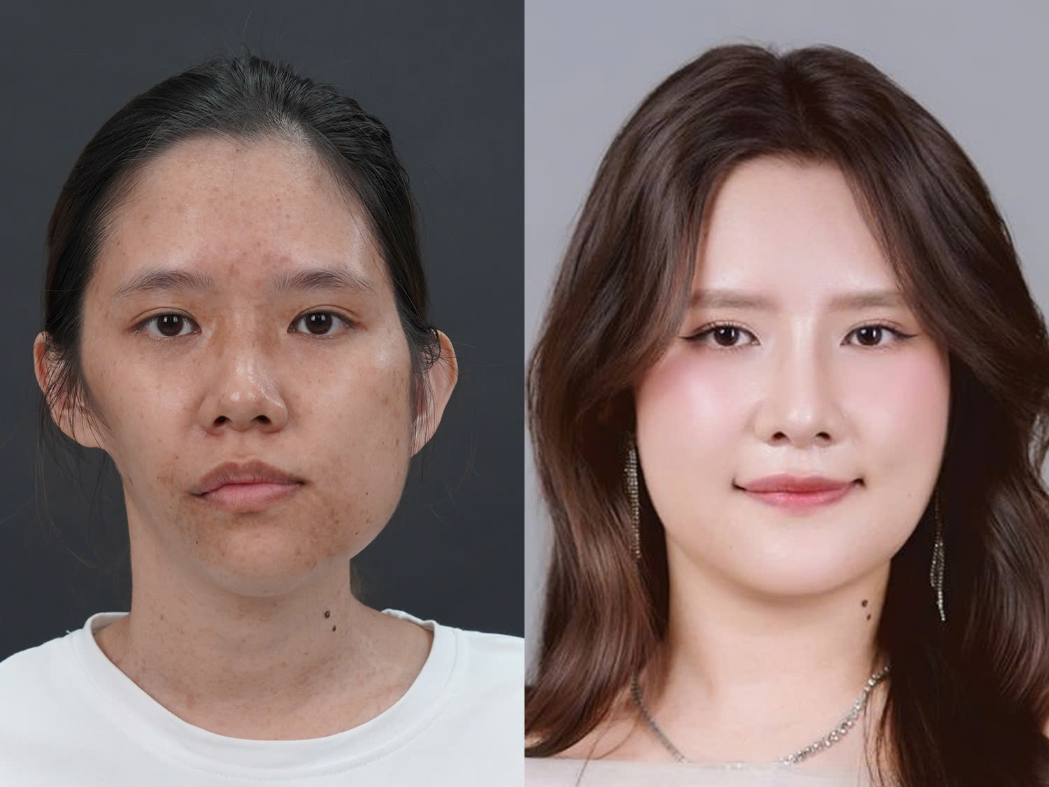 Kết quả phẫu thuật của Bảo Ngọc sau khi chỉnh hàm, gọt hàm, cấy ghép trung bì, cấy mỡ và nâng mũi. Khuôn mặt đã cân đối, hài hòa hơn