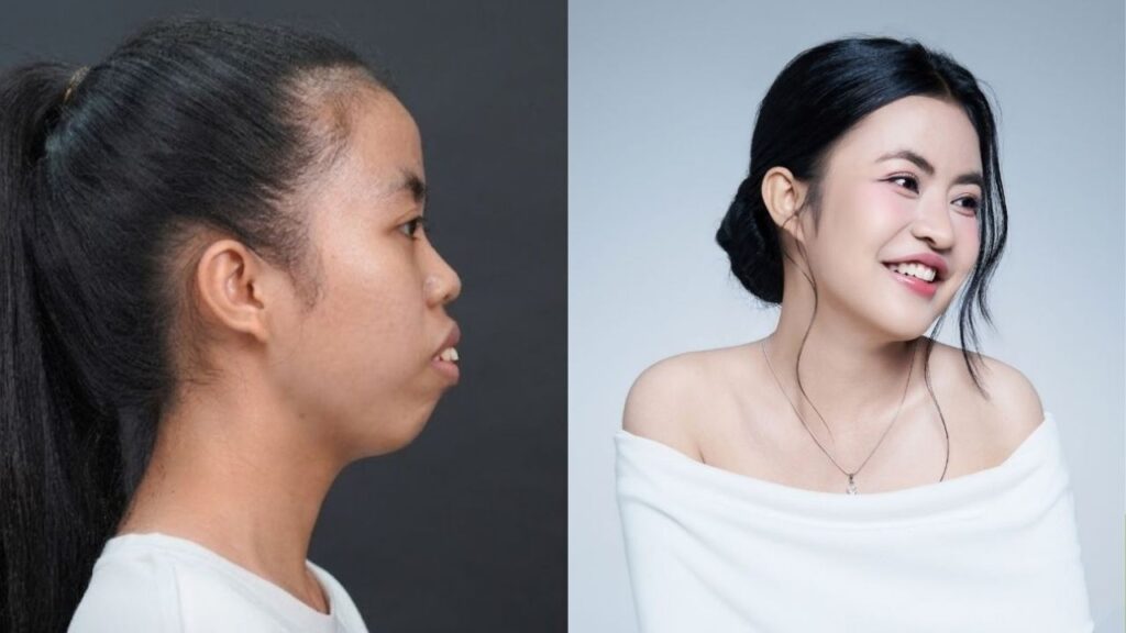 Báo chí nói gì về ca “lột xác” của Trương Thị Trà My: Vì sao chỉnh hàm chưa phải điểm kết?