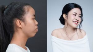 Báo chí nói gì về ca “lột xác” của Trương Thị Trà My: Vì sao chỉnh hàm chưa phải điểm kết?