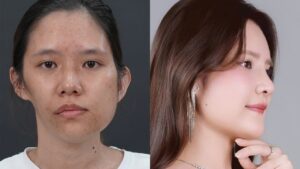 Bảo Ngọc lột xác hết bao nhiêu tiền? Chi phí phẫu thuật có như dịch vụ thông thường?