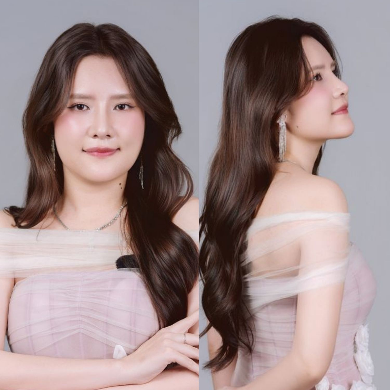 Sau phẫu thuật Bảo Ngọc sở hữu gương mặt cân đối, đường nét hài hòa, tình trạng hàm méo đã được khắc phục