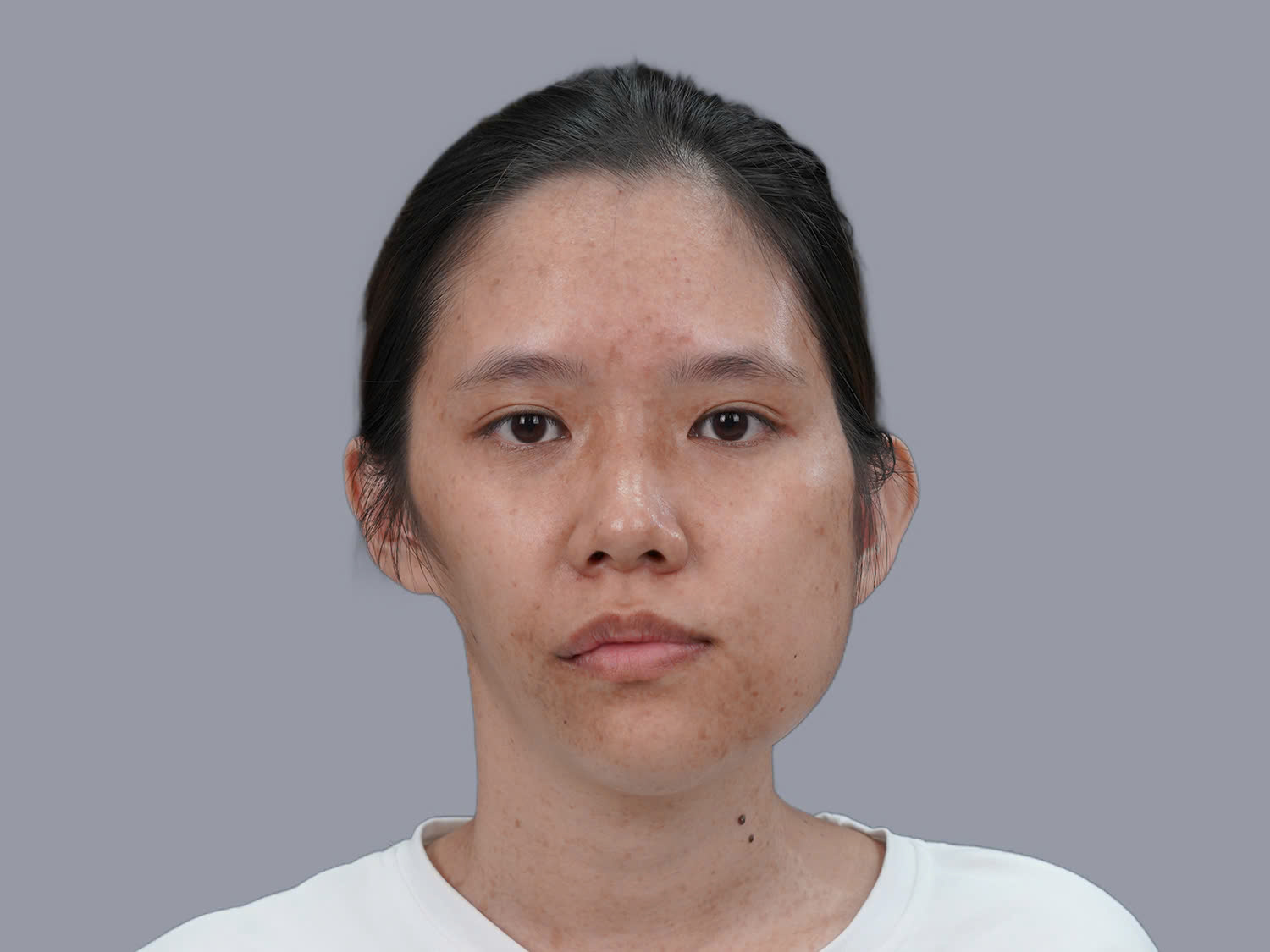 Võ Trần Bảo Ngọc gặp tình trạng một bên xương hàm phì đại, bên còn lại teo lép, mặt lệch, dáng mũi thấp