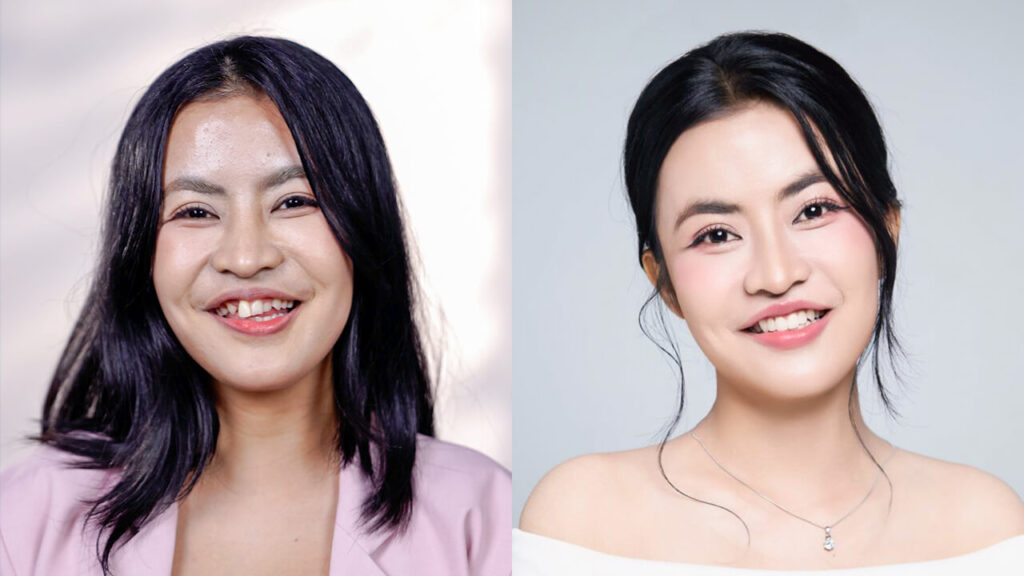 Bọc răng sứ sau chỉnh hàm Kangnam: Có nên thực hiện để hoàn thiện nụ cười không?