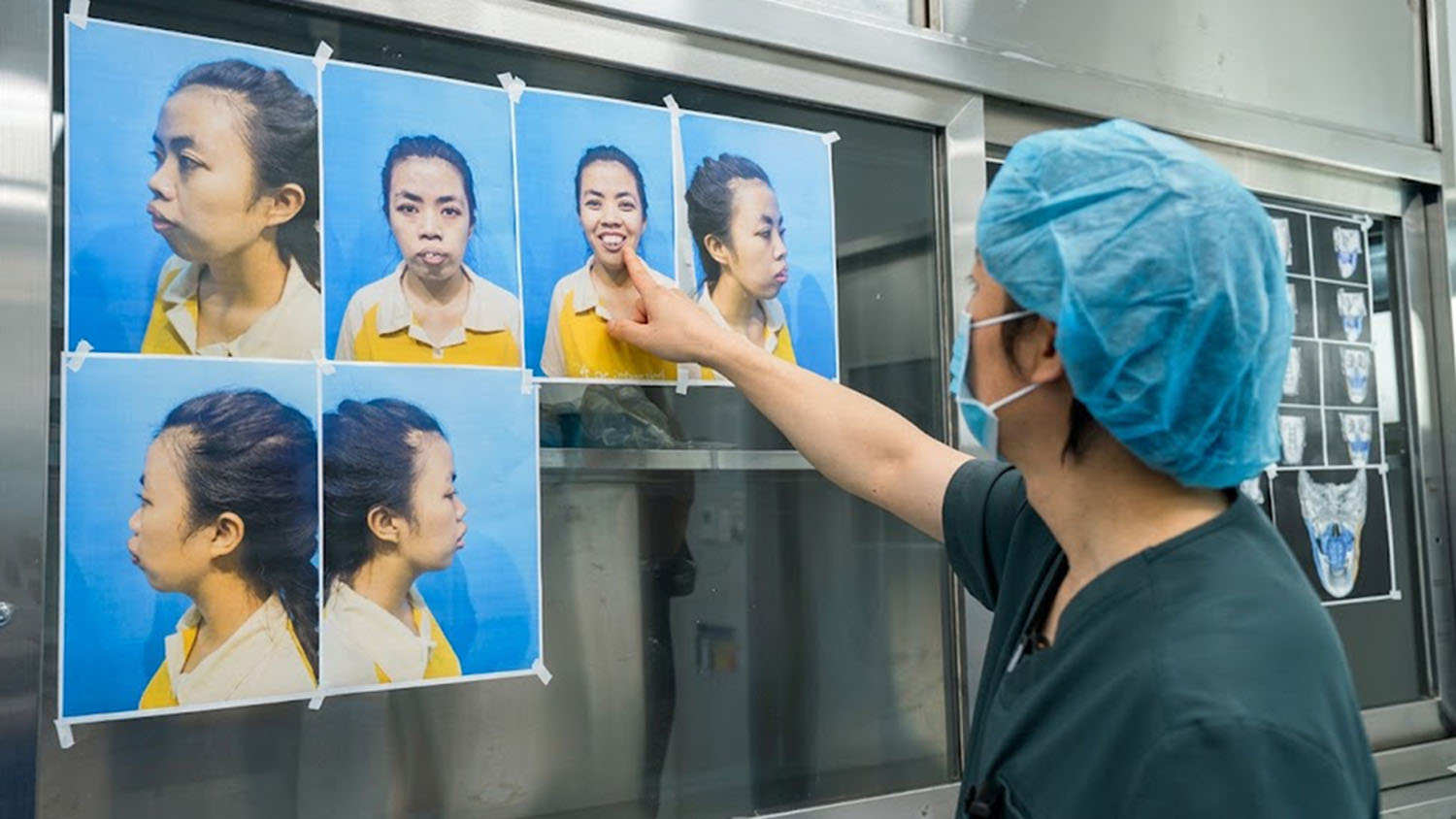 TS.BS Richard Huy đang phân tích tình trạng hàm mặt của Trà My để lên kế hoạch phẫu thuật