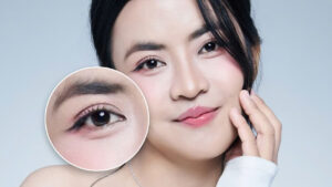 Tạo mắt 2 mí như Trà My khác gì so với cắt mí thông thông thường