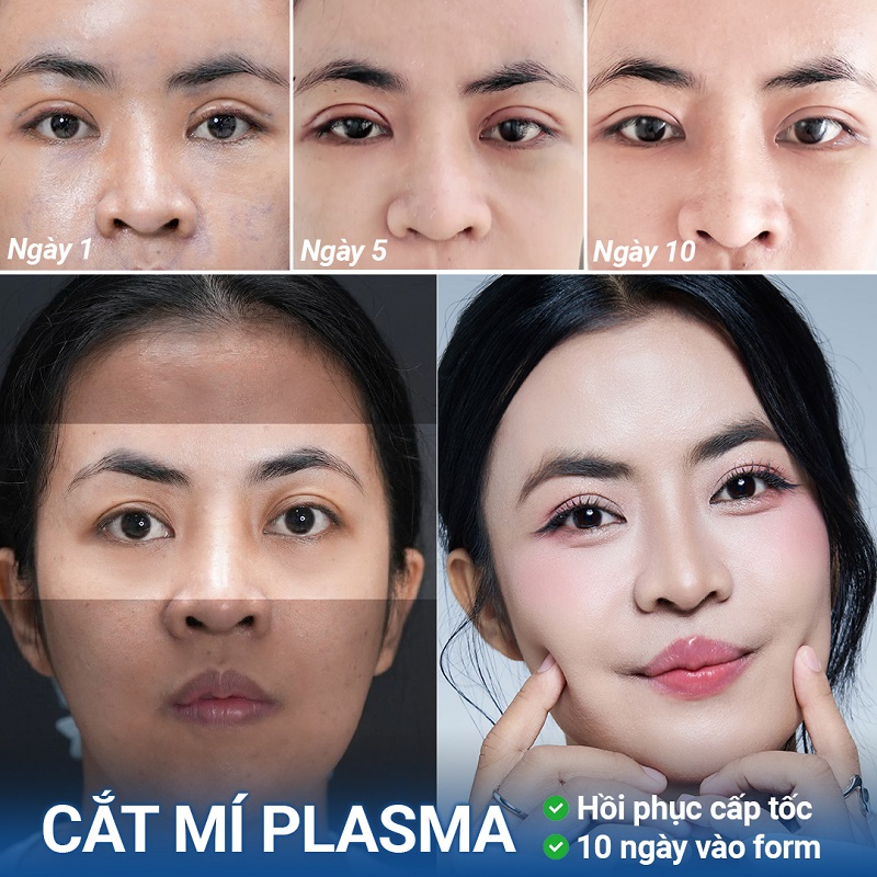 Quá trình phục hồi sau cắt mí Plasma của Trà My diễn ra trong 10 ngày, nếp mí dần hết sưng và tự nhiên