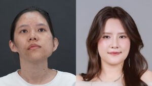 Cấy ghép trung bì mặt là gì? Kỹ thuật bổ sung thể tích mô mềm cho mặt lệch trong case Bảo Ngọc HTLX