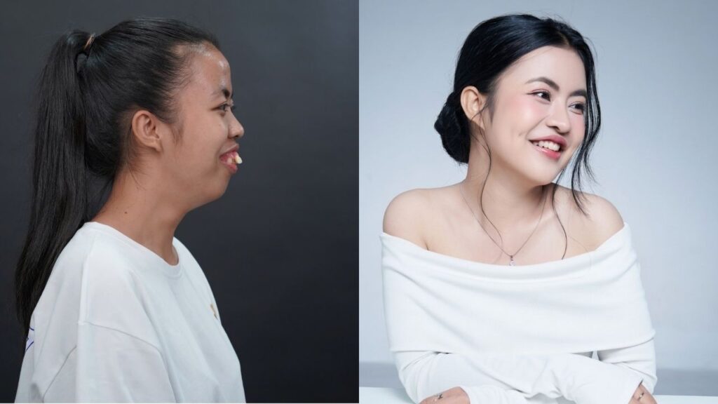 Cô gái bị gọi là ‘hàm nạo dừa’ thay đổi ngoạn mục sau hơn 20 năm mặc cảm