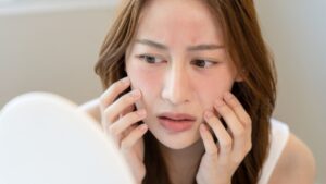 Hạ gò má bị hóp má: Nguyên nhân, dấu hiệu và cách khắc phục
