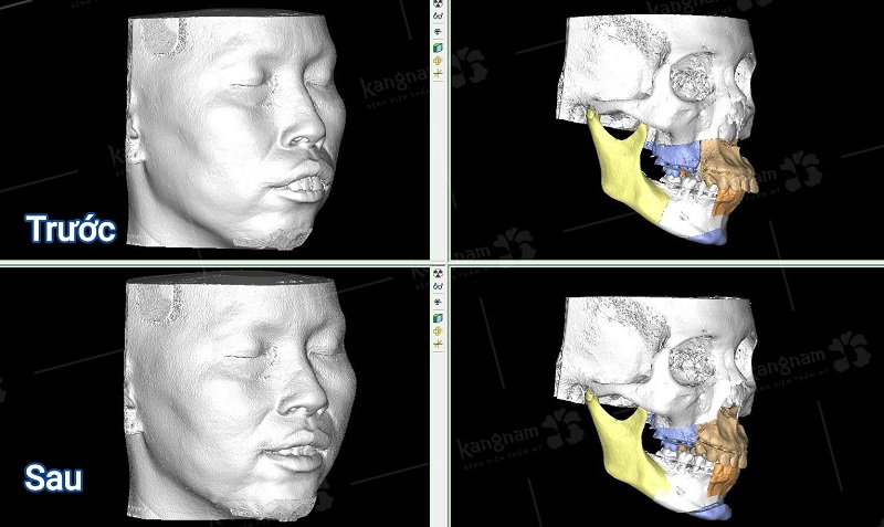 Công nghệ mô phỏng AI 3D lập kế hoạch tái phẫu thuật chỉnh hàm lần 2 giúp xác định chính xác vị trí cắt xương và đặt nẹp vít.