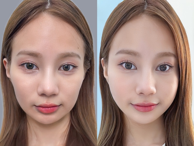Hình ảnh so sánh thực tế khách hàng trước và sau khi xử lý hóp má bằng công nghệ Bio Fat tại Kangnam.
