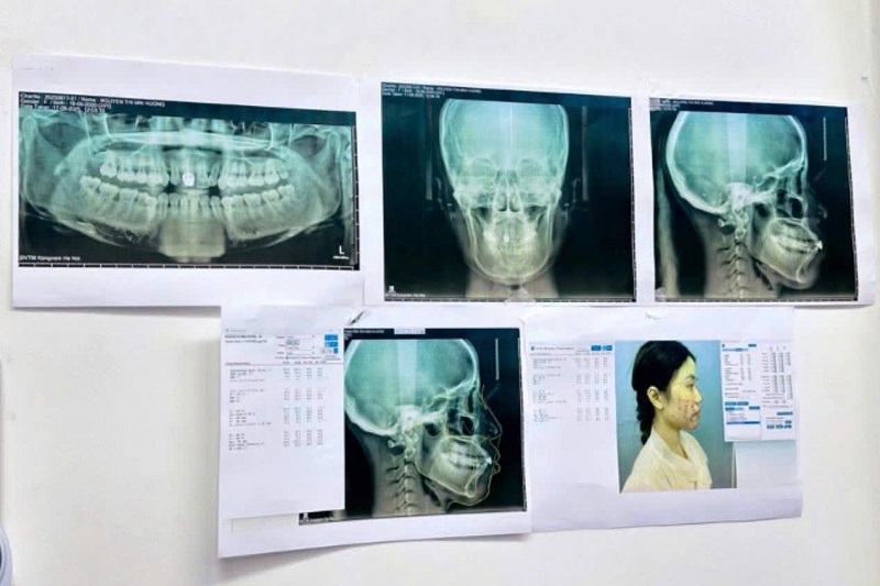 Việc xác định chính xác lộ trình dây thần kinh qua phim CT giúp bác sĩ tránh can thiệp trực tiếp vào vùng nhạy cảm.