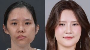 Mặt lệch do u bạch huyết: Nguyên nhân, ảnh hưởng và giải pháp phẫu thuật của ekip Kangnam