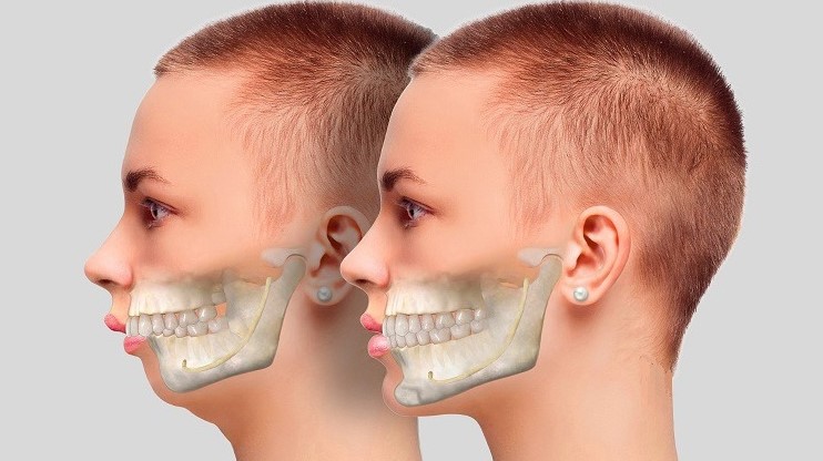  Mô phỏng vị trí dây thần kinh huyệt răng dưới – vùng nhạy cảm cần được bảo tồn tối đa trong phẫu thuật hàm.