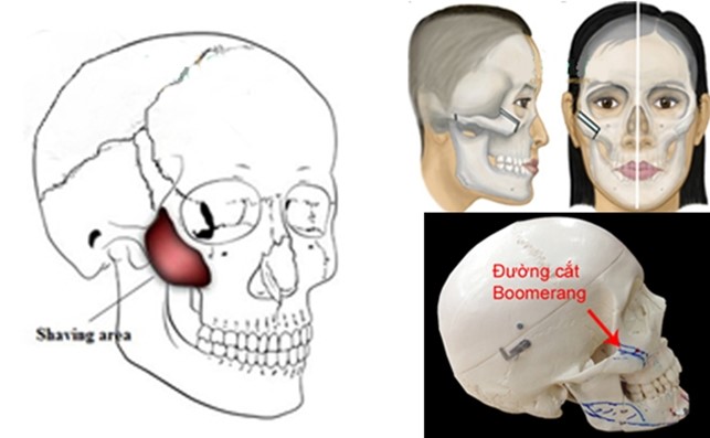  Hình ảnh mô phỏng sự tương quan giữa cấu trúc xương gò má và lớp mô mỡ đệm bên trên.
