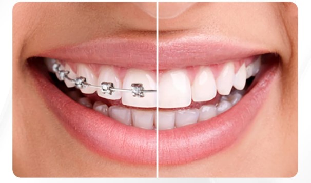 Bảng so sánh lựa chọn niềng răng, dán sứ Veneer và bọc răng sứ sau phẫu thuật hàm mặt tại Nha khoa Kangnam.