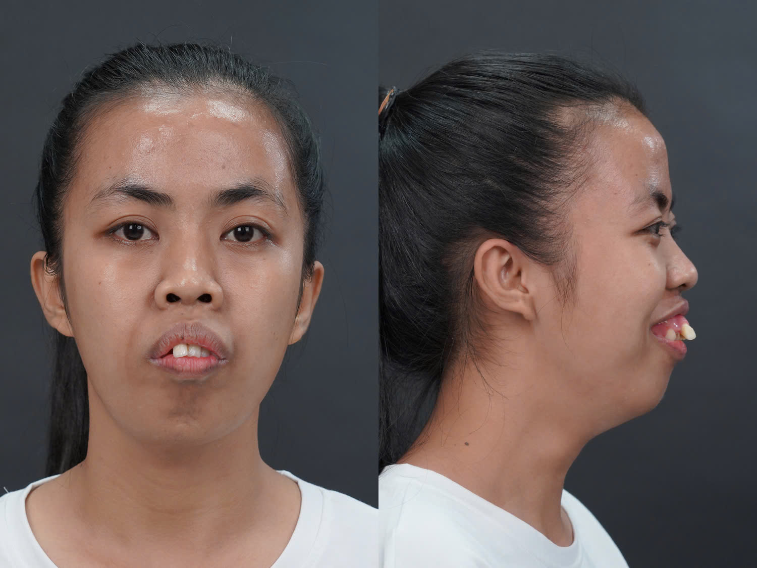 trà my trước khi tham gia lột xác gặp tình trạng hàm hô, cười hở lợi, mũi tẹt