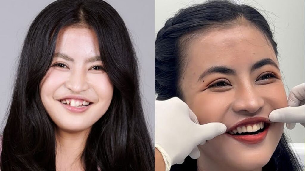 Phân tích ca “lột xác” của Trương Thị Trà My: Vì sao chỉnh hàm thôi là chưa đủ?