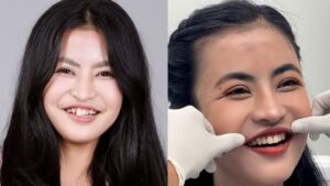 Phân tích ca “lột xác” của Trương Thị Trà My: Vì sao chỉnh hàm thôi là chưa đủ?