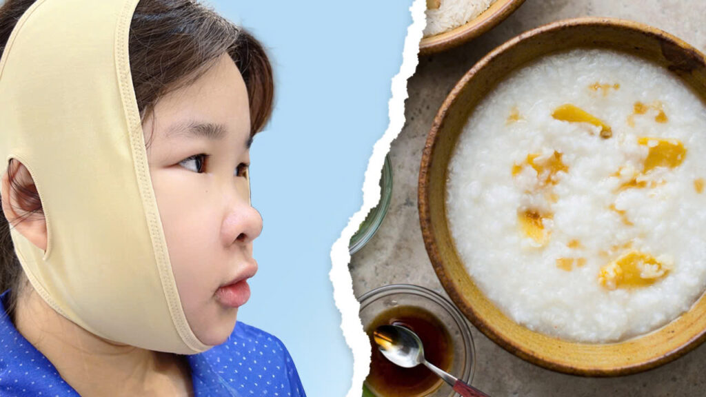 Sau chỉnh hàm hô ăn cháo bao lâu? 5 mốc thời gian hồi phục và chế độ ăn chuẩn y khoa