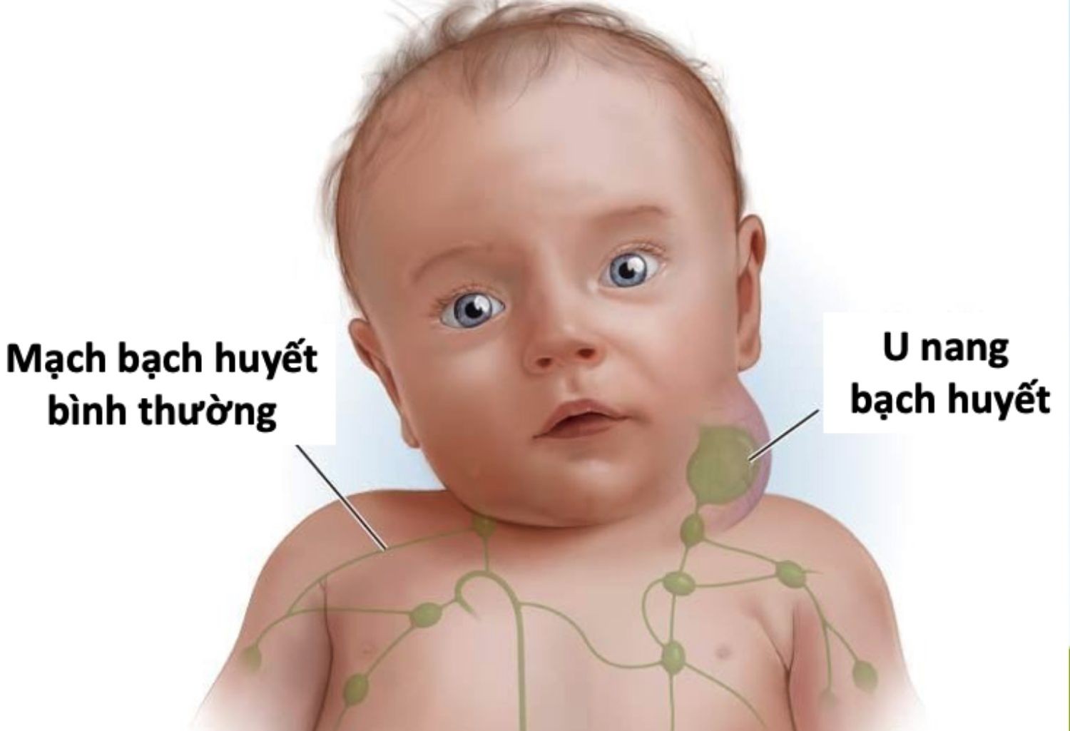 U bạch huyết (lymphangioma) là dạng dị tật bẩm sinh liên quan đến hệ bạch huyết gây biến dạng khuôn mặt
