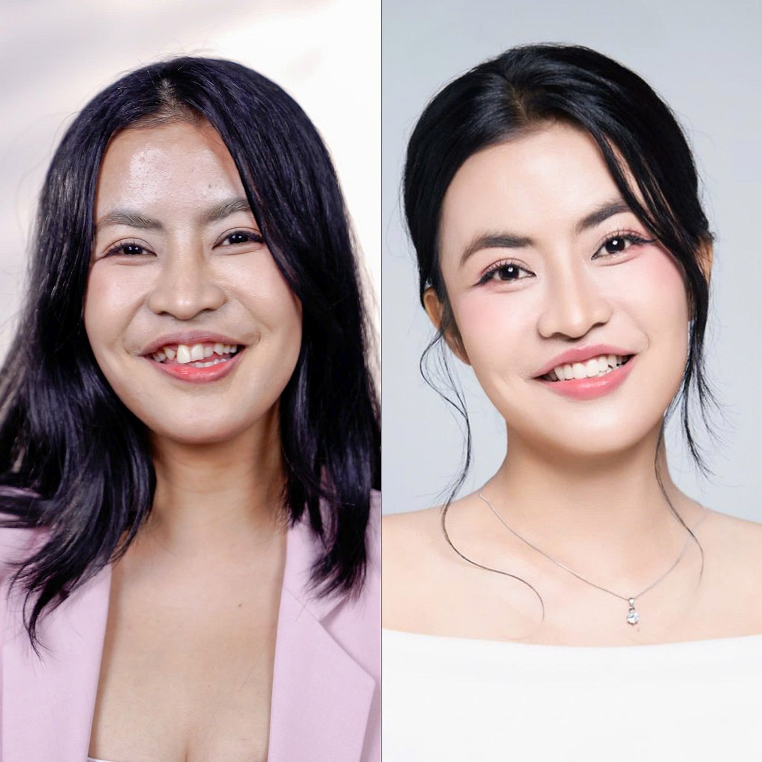 Kết quả bọc 5 răng sứ thẩm mỹ cho thí sinh Trương Thị Trà My sau phẫu thuật chỉnh hàm tại Hành Trình Lột Xác mùa 7.