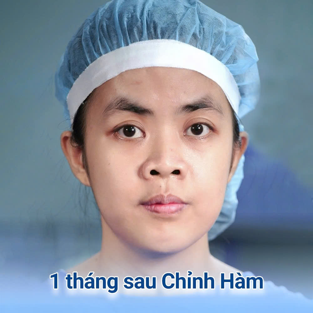 Trà My thực hiện chỉnh hàm trước sau đó mới tinh chỉnh các đường nét còn lại