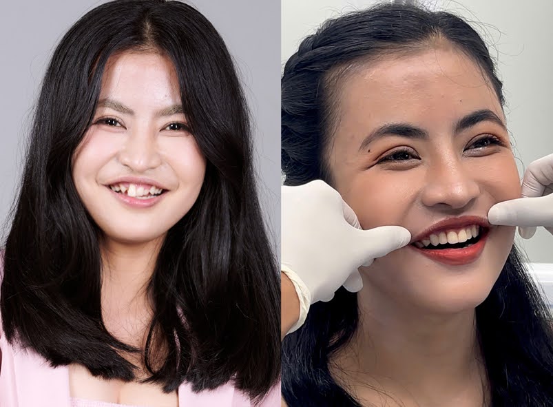 Trà My trước và sau khi bọc răng sứ, hoàn thiện nụ cười , nâng tầm nhan sắc để cô tự tin hơn