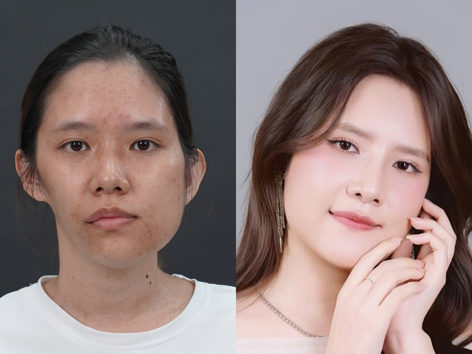 Bảo Ngọc trước và sau khi thay đổi ngoại hình, gương mặt cân đối, sống mũi cao cùng nụ cười tự nhiên