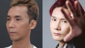 8 dịch vụ thẩm mỹ cho Lê Chí Nguyện – Chàng trai trẻ giấu mình sau hàm hô và sẹo rỗ