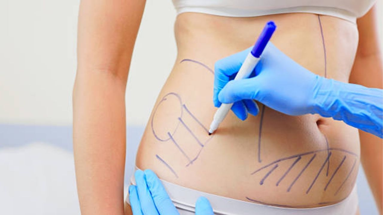 hút mỡ truyền thống nếu không kiểm soát tốt có thể tăng cân lại