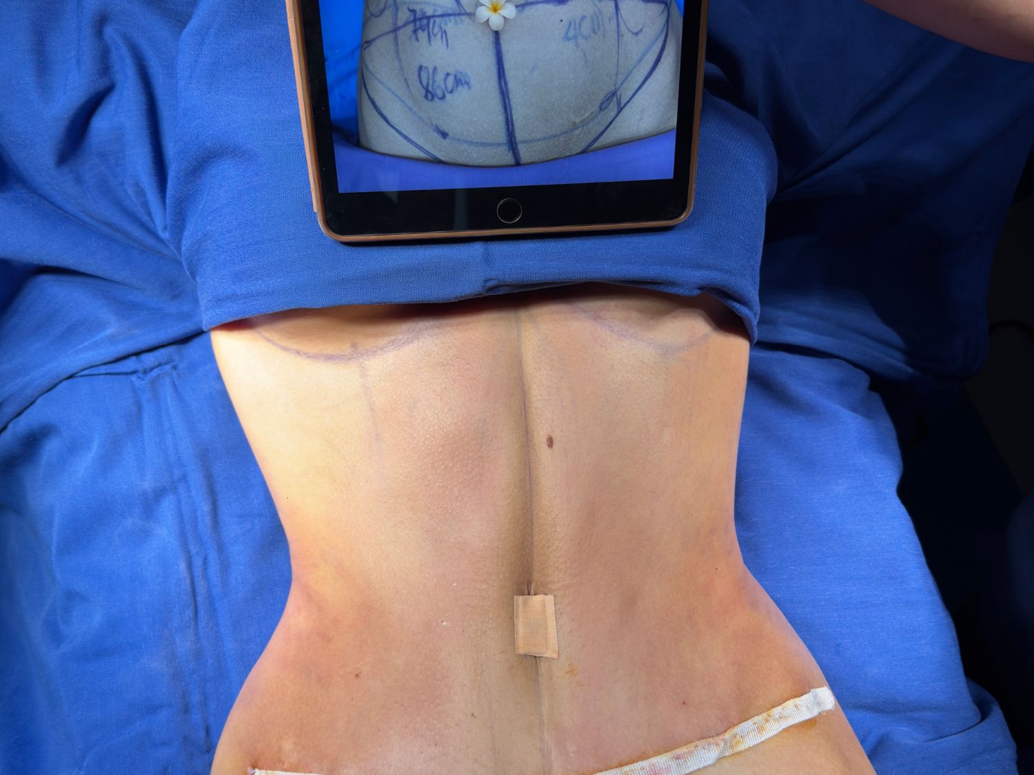 Kết quả hút mỡ sau 60 phút thực hiện hút mỡ Vaser Lipo tia sương của chị Diễm