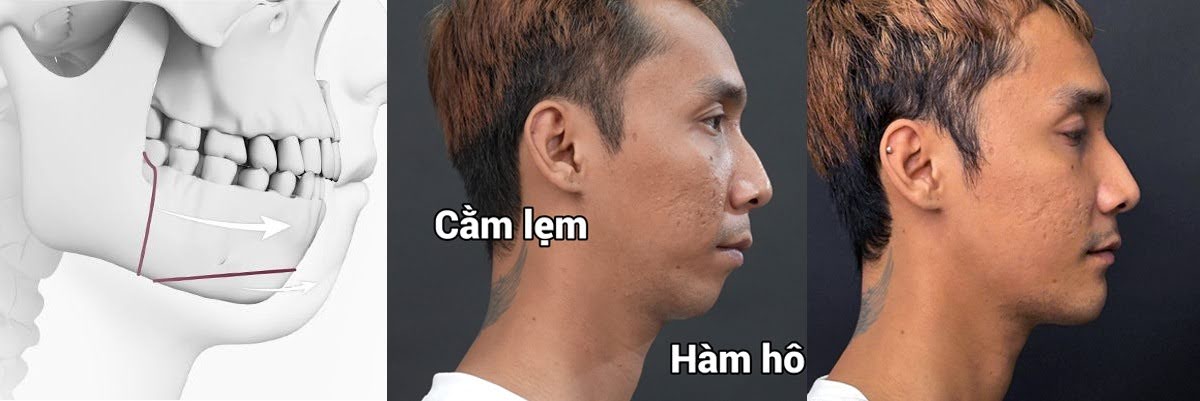 Lê Chí Nguyện sau chỉnh hàm hô & trượt cằm