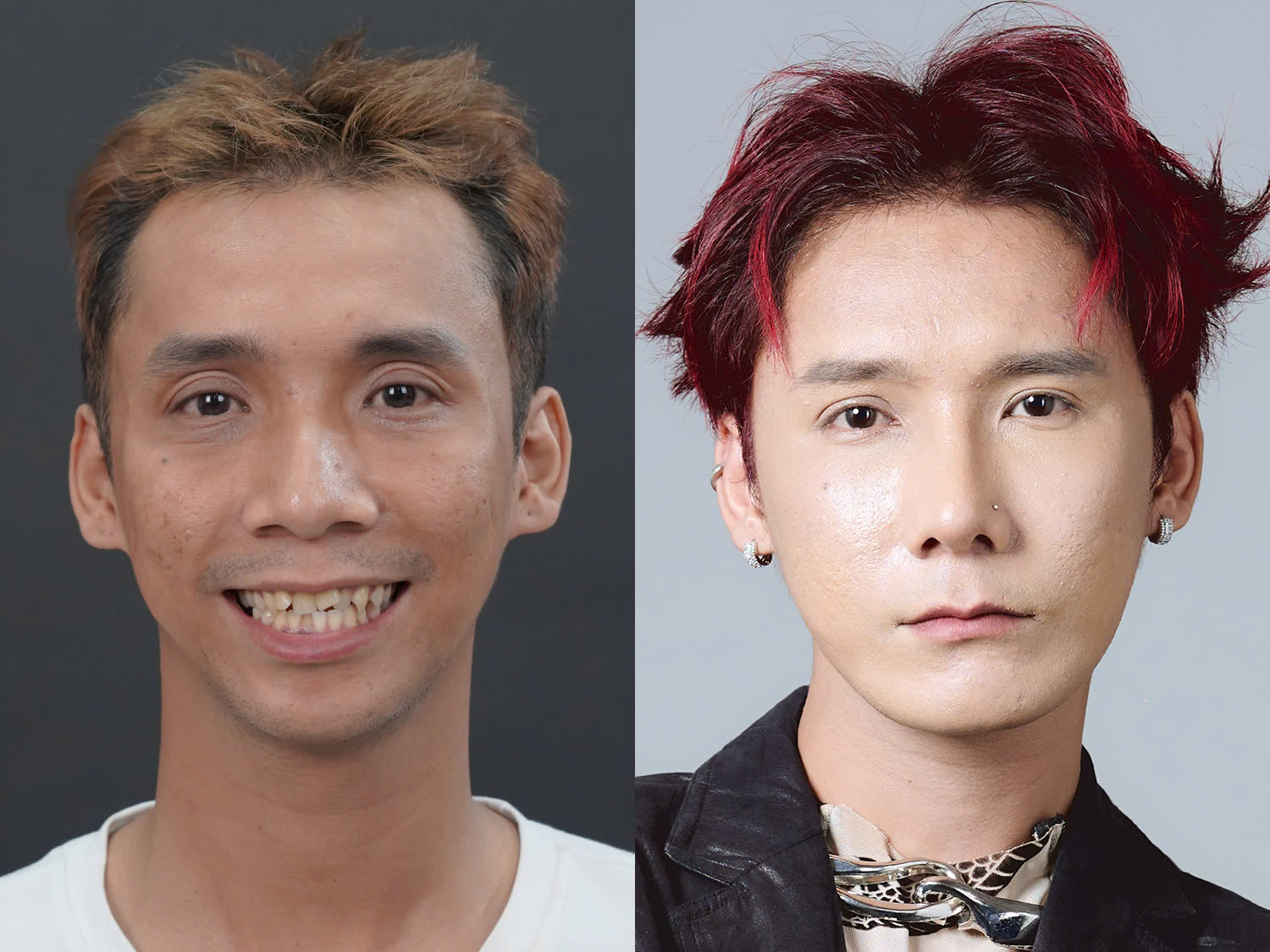 Lê Chí Nguyện trước và sau khi phẫu thuật,mũi cao thon, gương mặt nam tính hơn
