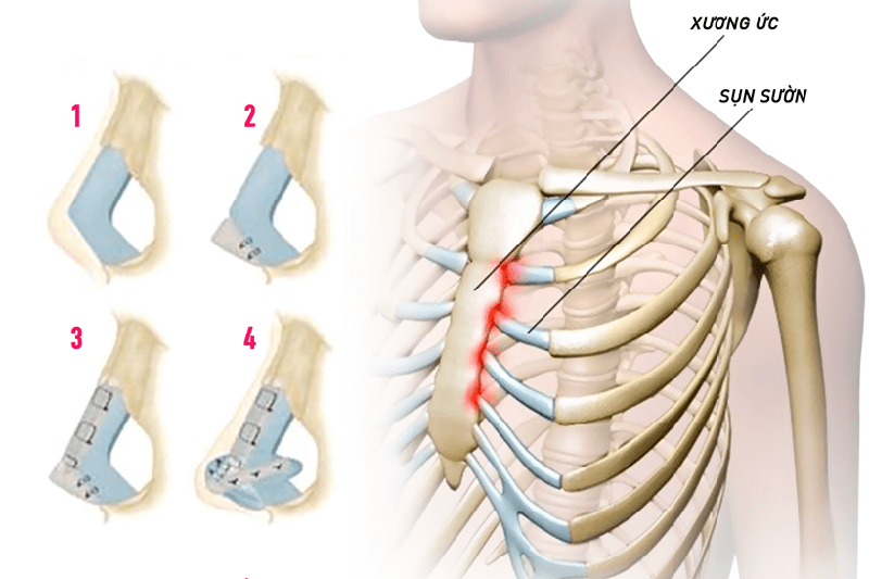 Sụn sườn số 7,8 được lấy để làm tái dựng trụ mũi, tạo dáng mũi vững chắc, ngăn ngừa đào thải