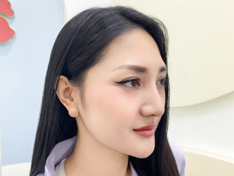 khách hàng sau khi nâng mũi idol tại Kangnam, dáng mũi cao hiện đại, phù hợp với khách hàng