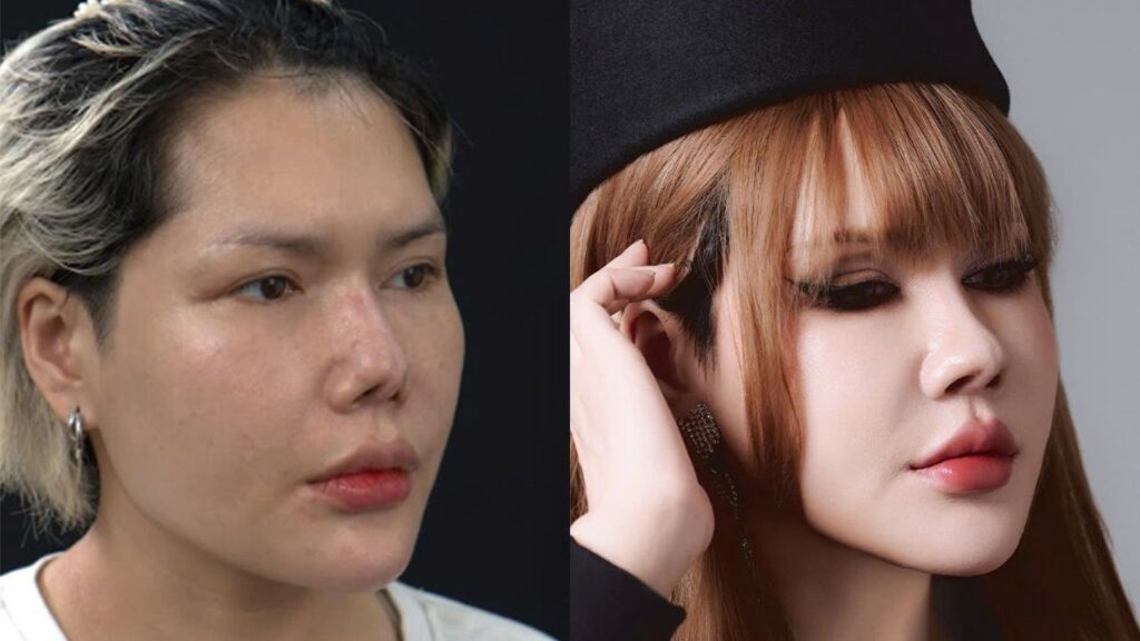 Sửa mũi hỏng nhiều lần bằng sụn sườn tự thân: Quy trình, chỉ định và 5 lưu ý từ ekip Hành trình Lột xác Mùa 7