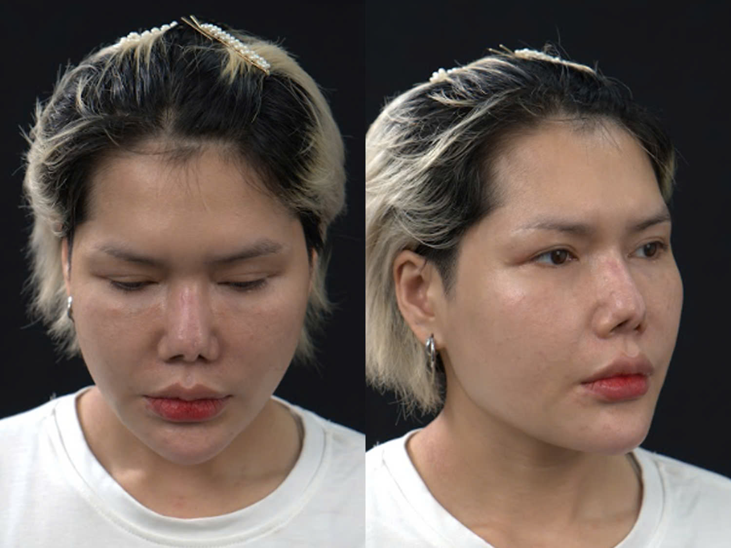 Quỳnh Mai bị hỏng mũi nghiêm trọng dù đã sửa 5 lần